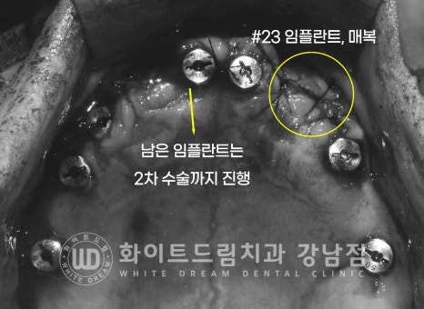 전체 임플란트 치료 기간과 내원 횟수는? "치과에 자주 가기 어려워요." 관련 이미지 13