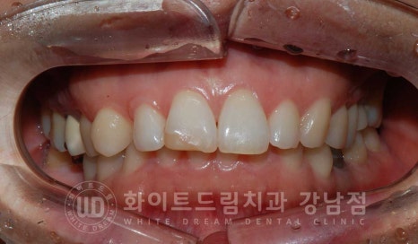 앞니 원데이라미네이트, 뻐드러지고 벌어진 앞니! 당일 치료 ok 관련 이미지 5