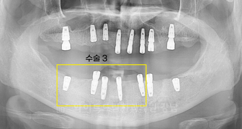 강남역 임플란트 치과 "틀니가 안 맞아서 불편해요" 틀니 → 전체 임플란트로! 관련 이미지 14