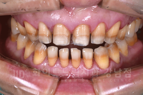 강남역 인근 치과 / 테트라사이클린(tetracycline) 치아 변색 / 라미네이트로 개선! 관련 이미지 12