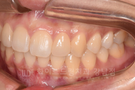 신논현역 라미네이트 / 과개교합 치아교정 + 왜소치 라미네이트 진행 case 관련 이미지 13