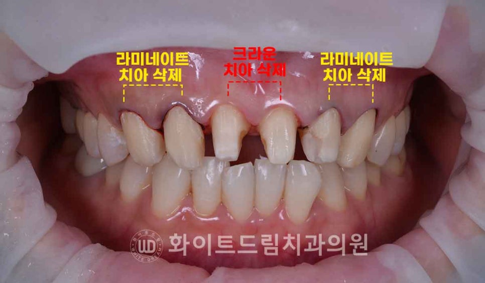 뱅뱅사거리치과 "라미네이트가 마음에 들지 않아요. 하얗고 균일한 치아를 갖고 싶어요." 강남역 화이트드림치과 관련 이미지 8