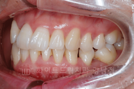 강남 덧니 비발치교정 / 임플란트와 치아교정 동시 진행 case 리뷰. 관련 이미지 16