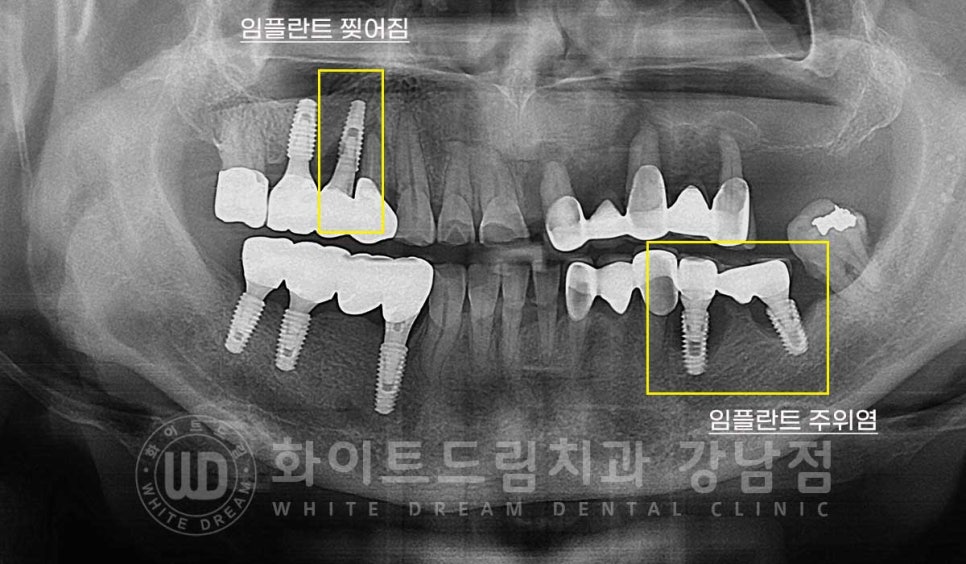 임플란트 재수술의 주원인, "임플란트 주위염과 임플란트 찢어짐!" 관련 이미지 3