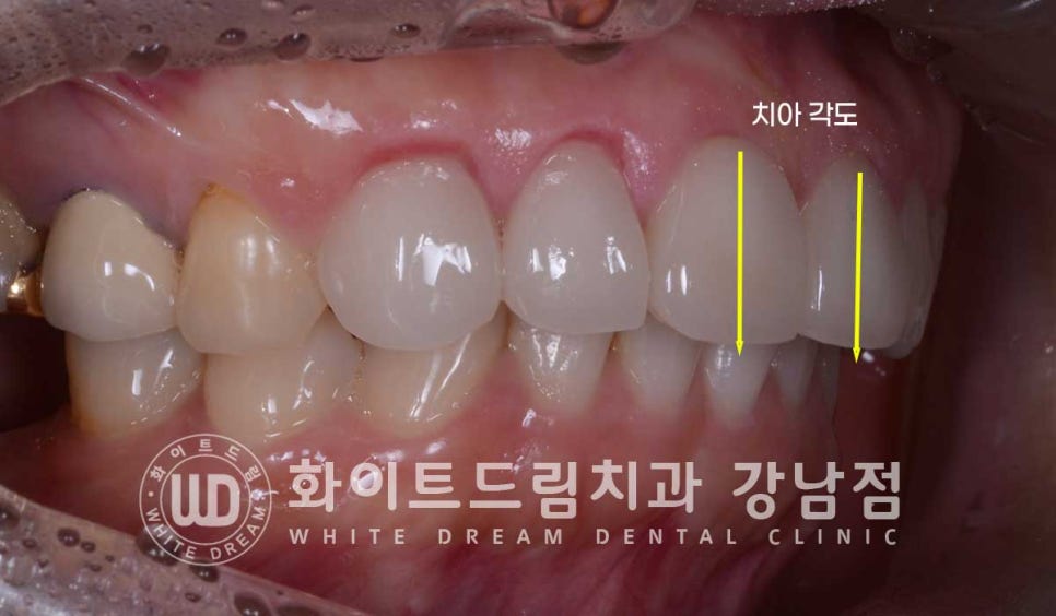 앞니 원데이라미네이트, 뻐드러지고 벌어진 앞니! 당일 치료 ok 관련 이미지 13