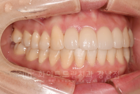 강남 덧니 비발치교정 / 임플란트와 치아교정 동시 진행 case 리뷰. 관련 이미지 23