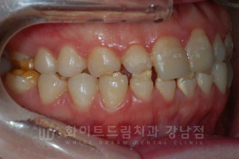 법랑질형성부전증, 라미네이트로 개선해요! / 강남역 라미네이트 치과 관련 이미지 13