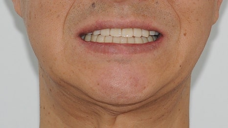 40대임플란트식립후기 및 어금니임플란트 가격, 종류 알아보기 위해 관련 이미지 21