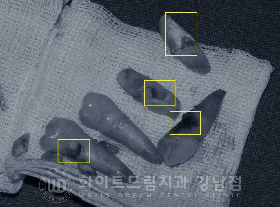 치주염 전체임플란트 치료 사례 / 치아를 흔들리게 만드는 치주염이란? 관련 이미지 1