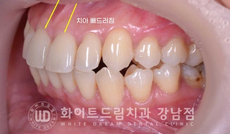 앞니 뻐드러짐 라미네이트 "뻐드러지고 벌어진 앞니" 당일 라미네이트 치료 case 관련 이미지 5