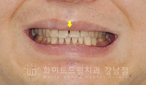 벌어지고 깨진 앞니, 웨딩 앞니 라미네이트 치료 사례 "남자도 자연스럽게 라미네이트 가능한가요?" 관련 이미지 14
