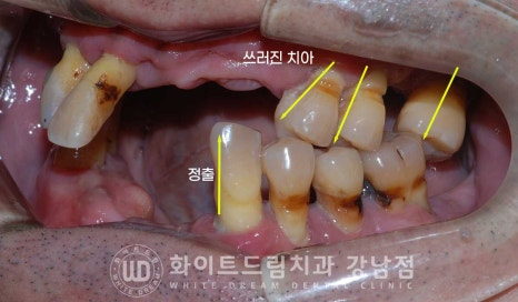치주염 전체임플란트, 염증으로 인한 상악동 천공 & 신경관 가까이 녹은 잇몸뼈. 임플란트 식립 가능할까? 관련 이미지 4