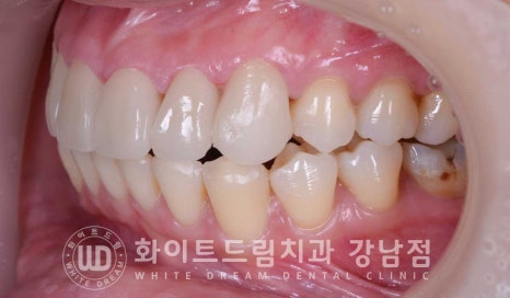앞니 뻐드러짐 라미네이트 "뻐드러지고 벌어진 앞니" 당일 라미네이트 치료 case 관련 이미지 14