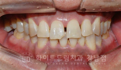 벌어지고 깨진 앞니, 웨딩 앞니 라미네이트 치료 사례 "남자도 자연스럽게 라미네이트 가능한가요?" 관련 이미지 4