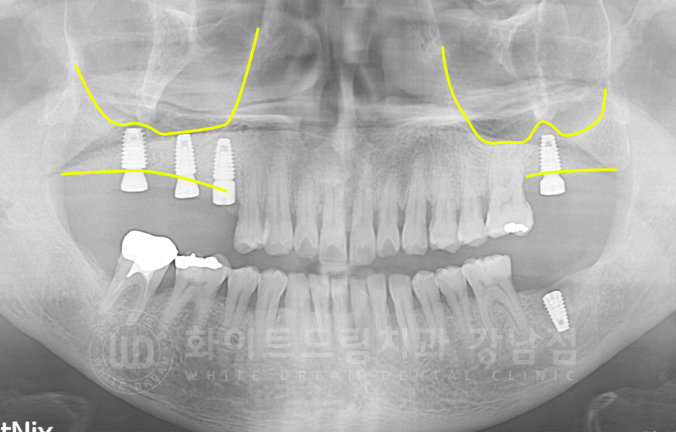 서초동 어금니 임플란트 / 강남역 화이트드림치과 : 상악동 거상술 (crestal approch) 관련 이미지 11