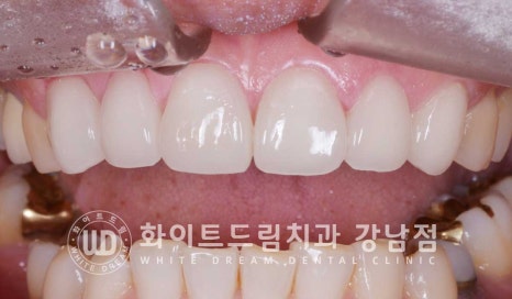 앞니 원데이라미네이트, 뻐드러지고 벌어진 앞니! 당일 치료 ok 관련 이미지 17