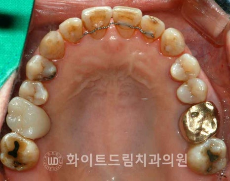 강남역어금니임플란트 치료 시 흔히 동반되는 상악동거상술 (Lateral window 방식), "잘 됐는지 어떻게 확인하죠?" 관련 이미지 3