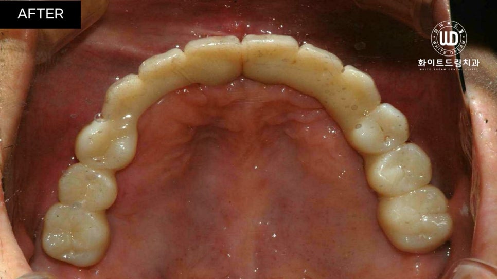 전체임플란트 식립 및 임플란트뼈이식 후기 관련 이미지 8