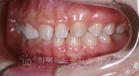 강남역 라미네이트 "치아가 작고 벌어졌어요" 거미스마일 + 벌어진 치아 개선 관련 이미지 13