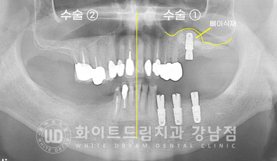 임플란트 개수를 줄일 수 있는 방법? (+치아를 발치한지 오래되었나요?) 관련 이미지 9