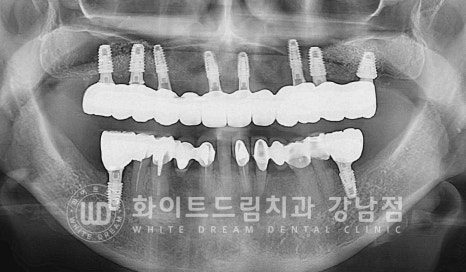 상악 풀케이스임플란트 사례 "부산에서 강남까지 왔어요" 관련 이미지 14