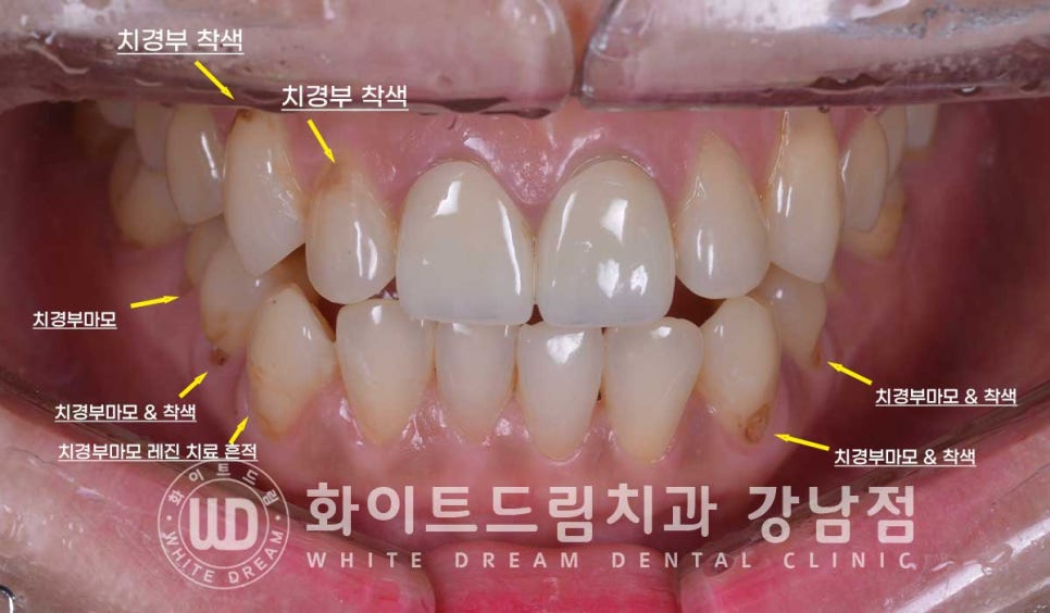 치경부착색 치료 / 라미네이트 vs 올세라믹 치아 삭제량 비교 (Feat. 라미네이트 후 치아미백 가능한가요?) 관련 이미지 7