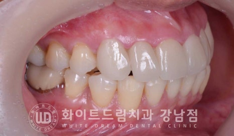 앞니 뻐드러짐 라미네이트 "뻐드러지고 벌어진 앞니" 당일 라미네이트 치료 case 관련 이미지 15