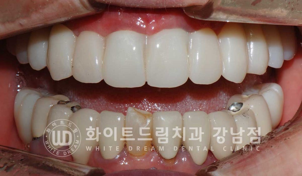 상악 풀케이스임플란트 사례 "부산에서 강남까지 왔어요" 관련 이미지 15