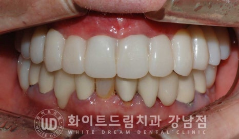 상악 풀케이스임플란트 사례 "부산에서 강남까지 왔어요" 관련 이미지 3