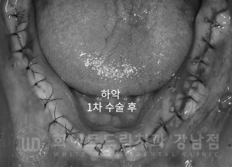 서울 전체임플란트 기간 / 전체 임플란트 7개월 완성, 무치악 임플란트 관련 이미지 9
