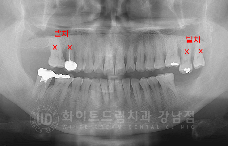 서초동 어금니 임플란트 / 강남역 화이트드림치과 : 상악동 거상술 (crestal approch) 관련 이미지 5