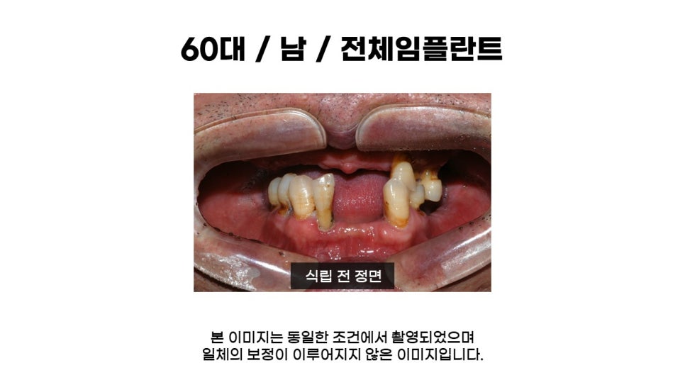 어금니임플란트 수복 및 당뇨환자임플란트 가격, 종류, 통증 관련 이미지 1