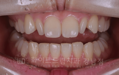 강남역 심미치과 "치아 하나가 유난히 작아요" #왜소치라미네이트 관련 이미지 8