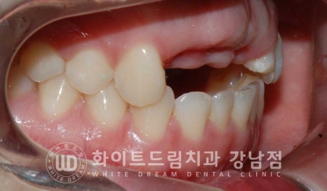 앞니 빠짐 임플란트 / 사고로 인한 앞니 탈구. 앞니 임플란트 치료는? 관련 이미지 15