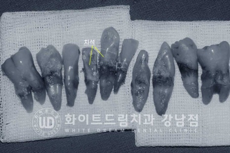 강남역 전악임플란트치과 / 치주 질환이 치아와 임플란트에 끼치는 영향! 관련 이미지 8