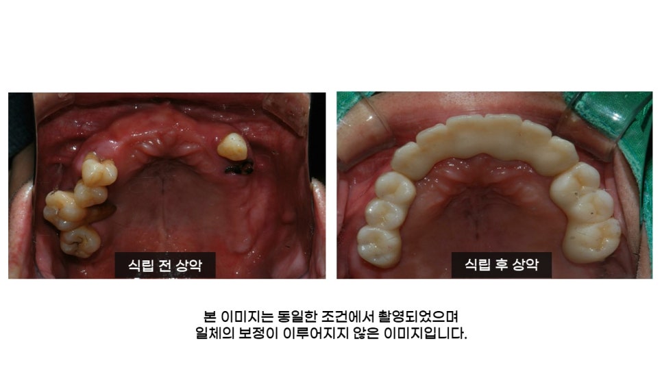 40대임플란트식립후기 및 어금니임플란트 가격, 종류 알아보기 위해 관련 이미지 18