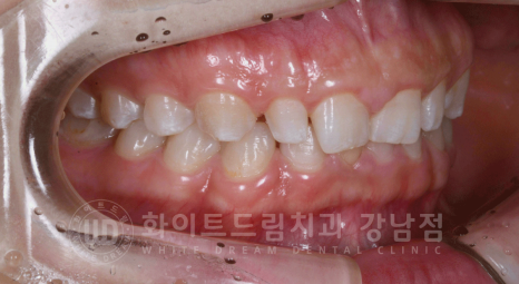 강남역 라미네이트 "치아가 작고 벌어졌어요" 거미스마일 + 벌어진 치아 개선 관련 이미지 15