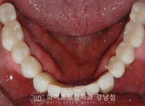 치주염 전체임플란트, 염증으로 인한 상악동 천공 & 신경관 가까이 녹은 잇몸뼈. 임플란트 식립 가능할까? 관련 이미지 19