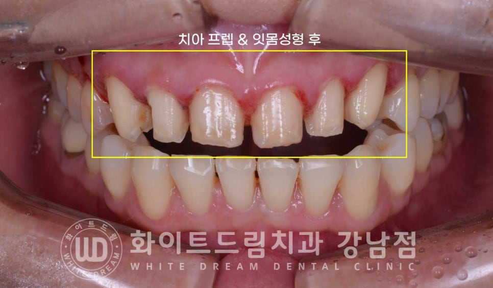 앞니 뻐드러짐 라미네이트 "뻐드러지고 벌어진 앞니" 당일 라미네이트 치료 case 관련 이미지 11