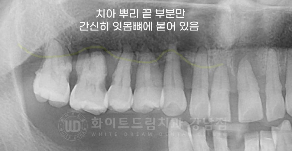 강남역 전악 임플란트 "치아가 흔들리고 빠져요!" 치주염 임플란트 치료 관련 이미지 2