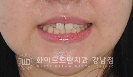 신경치료 후 크라운을 씌워야 하는 이유 & 신경치료 후 변색 치료 Case 리뷰 관련 이미지 2