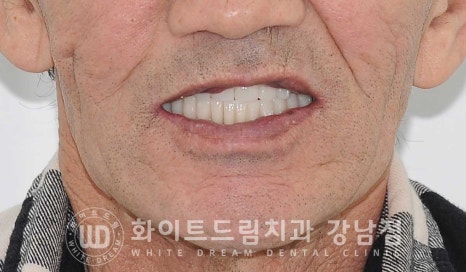 전체 임플란트 치료 기간과 수술 후 나타나는 변화는? 관련 이미지 2