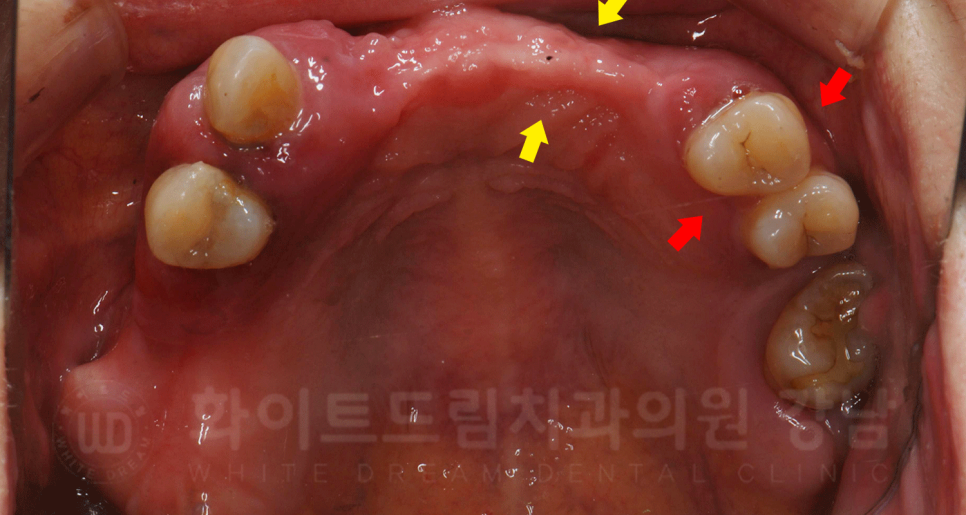 강남역 임플란트 치과 "틀니가 안 맞아서 불편해요" 틀니 → 전체 임플란트로! 관련 이미지 3
