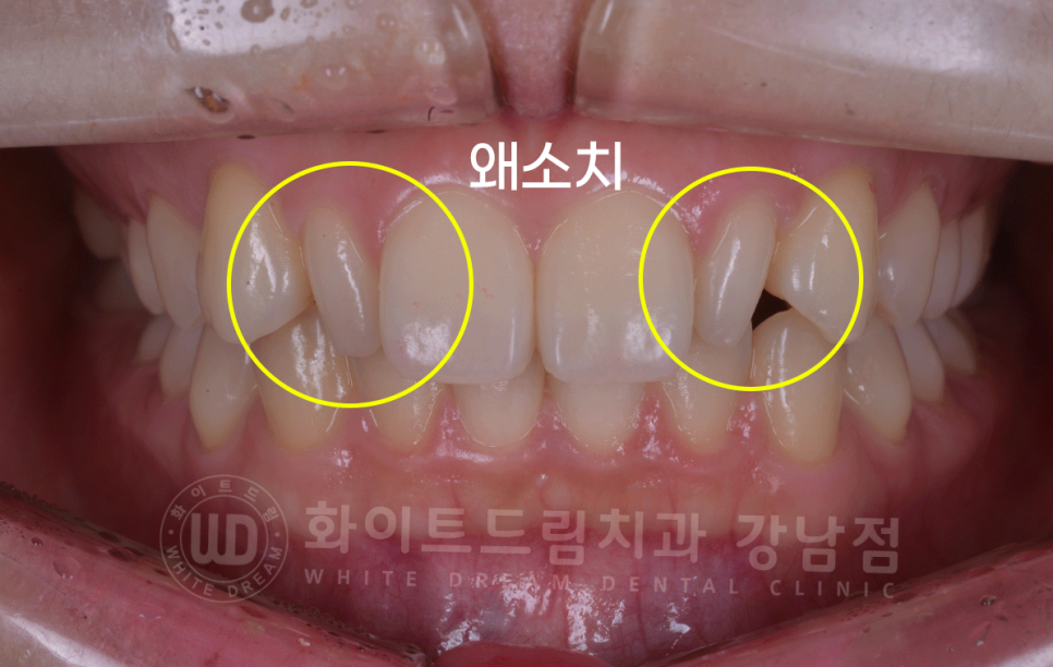 강남역 심미치과 "치아 하나가 유난히 작아요" #왜소치라미네이트 관련 이미지 3