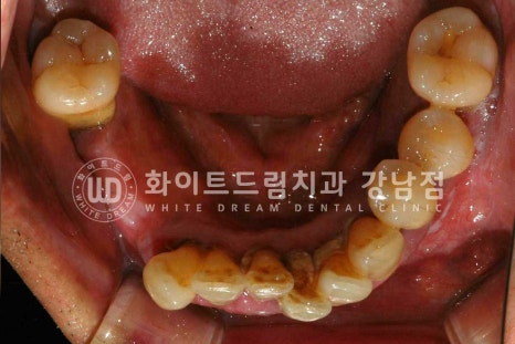 강남역 전악임플란트치과 / 치주 질환이 치아와 임플란트에 끼치는 영향! 관련 이미지 14