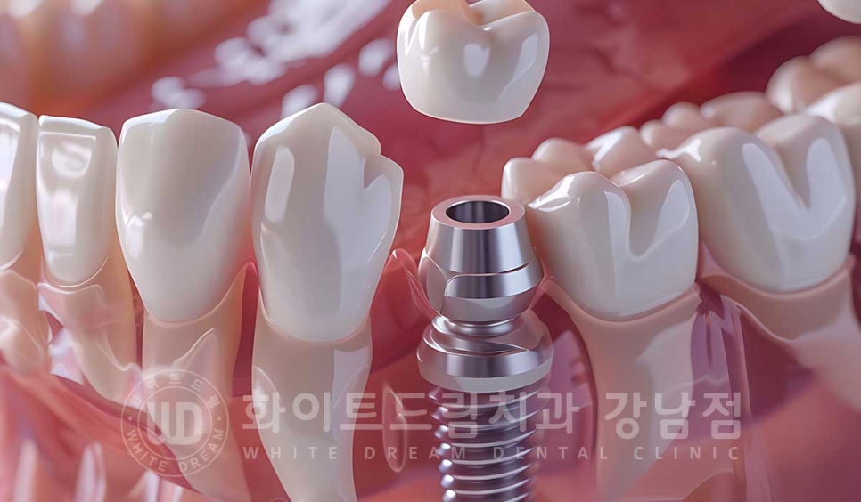 임플란트 재수술의 주원인, "임플란트 주위염과 임플란트 찢어짐!" 관련 이미지 9