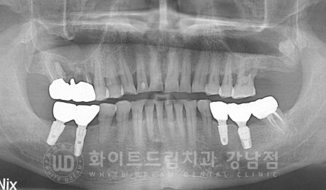 [흔들리는 어금니크라운] 흔들리고 냄새나는 오래된 크라운, 원인은? 관련 이미지 3
