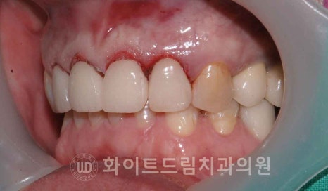 신논현역 당일 라미네이트, "길이가 다른 깨진 앞니" 당일 앞니 라미네이트 치료 과정은? 관련 이미지 14