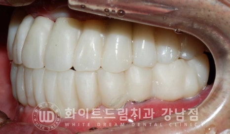 전체 임플란트 치료 기간과 수술 후 나타나는 변화는? 관련 이미지 12