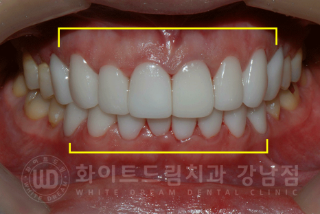 강남역 앞니라미네이트 "틀어진 토끼 앞니 빠르게 개선" 강남역 라미네이트 치과 관련 이미지 7